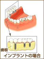 インプラント
